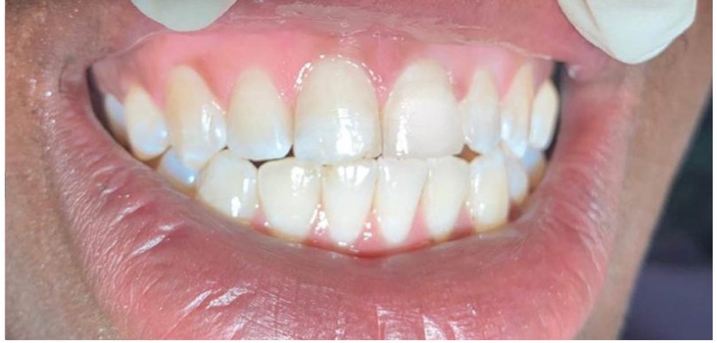 Repaired, even smile after treatment at 360 Dental