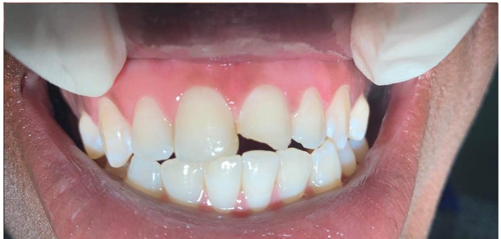 Smile with a chipped front tooth, before treatment at 360 Dental