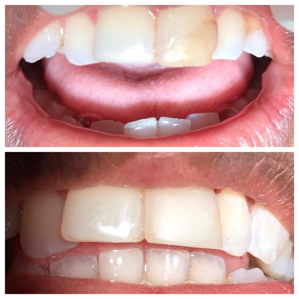 Before and after of cosmetic bonding on discoloured front teeth at 360 Dental