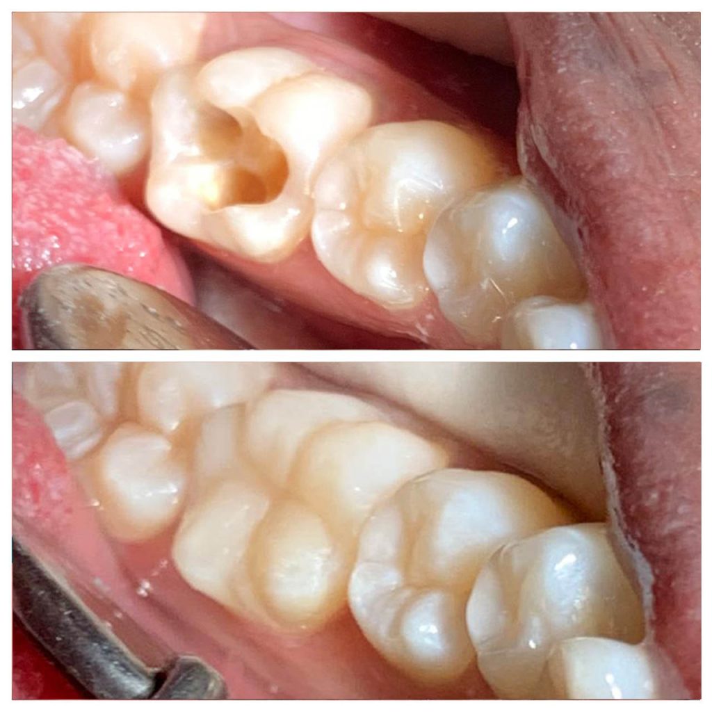 Before and after of a tooth-coloured filling replacing a cavity at 360 Dental