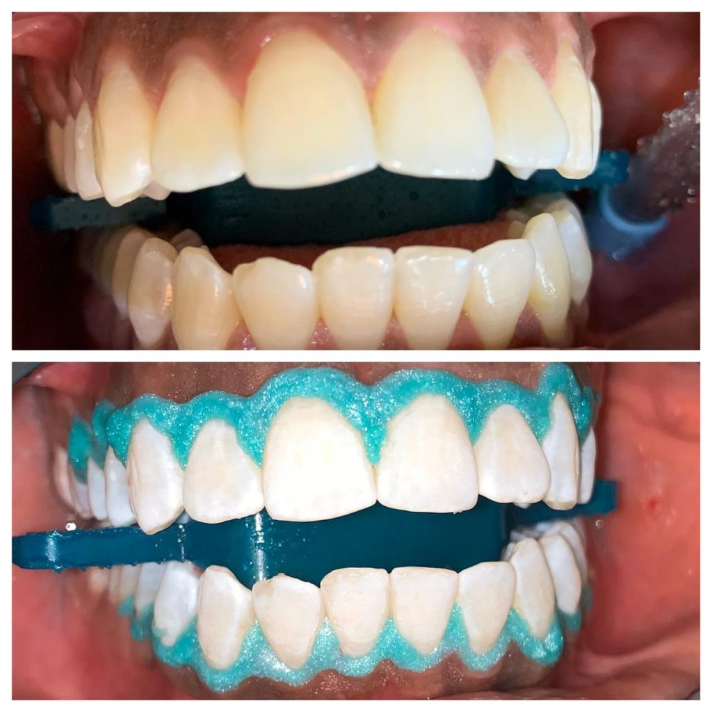 Before and after of professional teeth whitening at 360 Dental